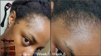 Where to Find Virgin Hair Fertilizer