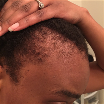 Pictures of Virgin Hair Fertilizer